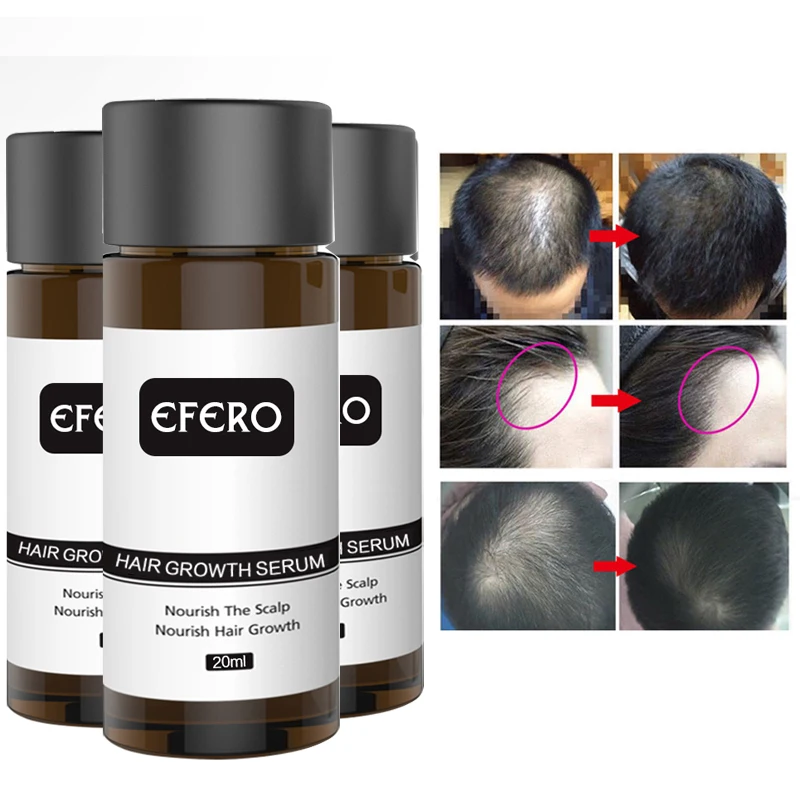 5PCS Fast Powerful Hair Growth Essence Products Essential Treatment Preventing Hair Loss Restoration Regrowth Hair Care Serum