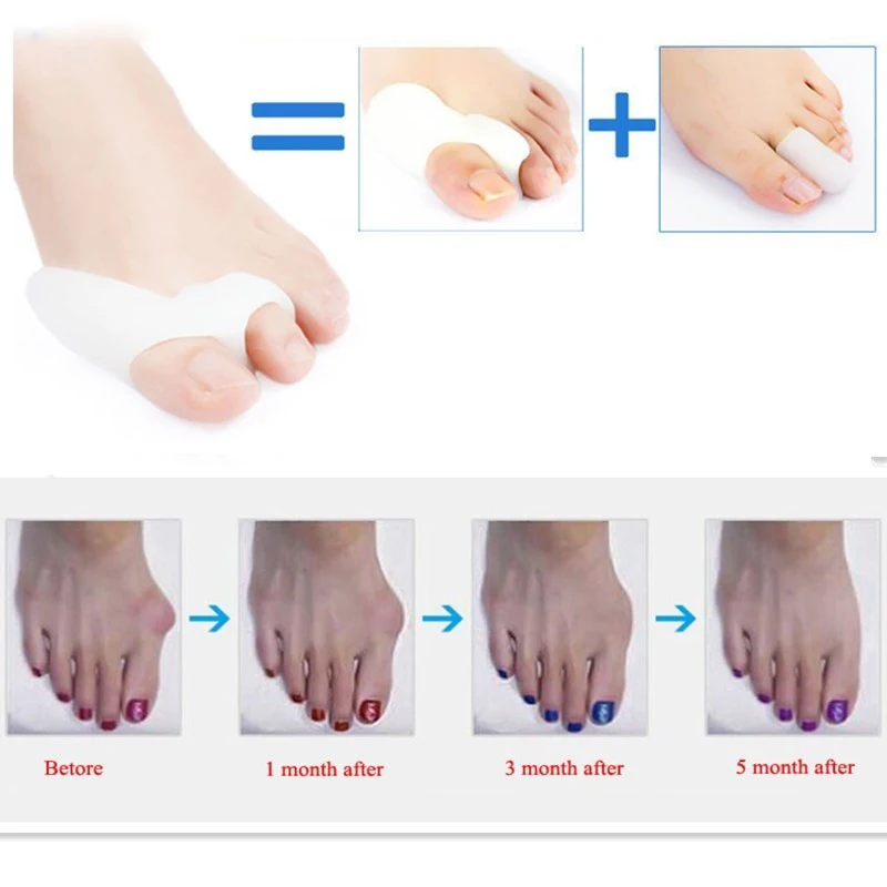 2 шт. корректор для ног гель педикюр носилки Bunion протектор Выпрямитель Корректор Уход за ногами