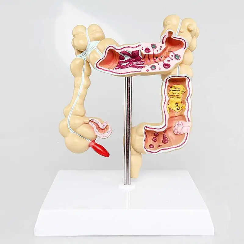 Колоректального модель поражения человека толстой кишки для стоматологов патологическая заболеваний модель медицинский Органайзер анатомия