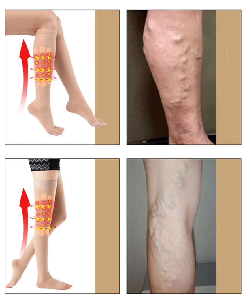 Compression stockings 1