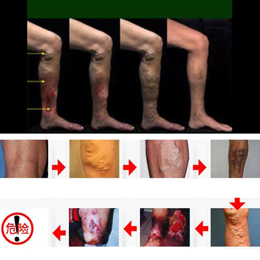 Облегчение отеков ног крем варикозное расширение вен боль варикозное расширение вен и паук вен натуральные травы массажный крем D002