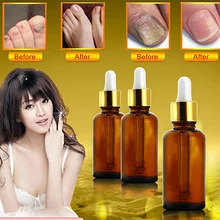 Finger Toe Repair Essence Liquid Nail Fungus Onychomycosis Removal Treatment Oil smt 101