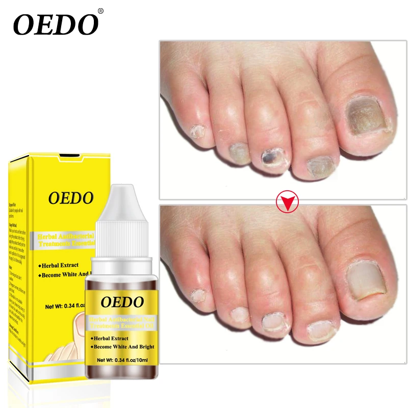 Herbal Antibacterial Nail Treatments Essential Oil Herbal Extract Nail Fungus Art Repair Tools Foot Nail Care Improve Infection