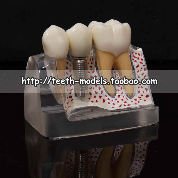 Человеческие модели зубного имплантата Речевая модель имплантата клинический ремонт традиционные, керамические мосты Ремонт