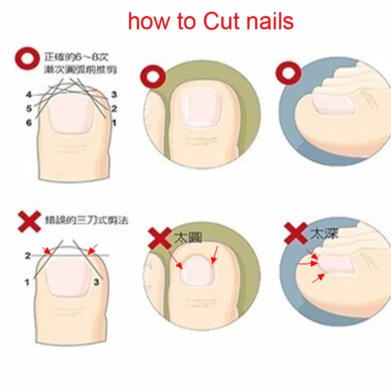 Новинка,, вросшие ногти, вальгусная деформация, корректор для педикюра, cuidado de los pies alluce valgo, инструменты для педикюра