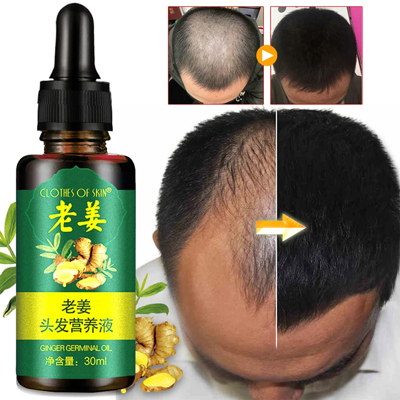 30ml Anti Hair Loss Liquid Ginger Hair Growth Serum Essence for Women and Men Damaged Hair Repair Growing Faster Repair UZ85