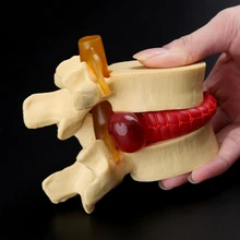 Modèle d'accessoires médicaux affranchissement gratuit anatomique colonne vertébrale lombaire hernie discale anatomie outil d'enseignement médical