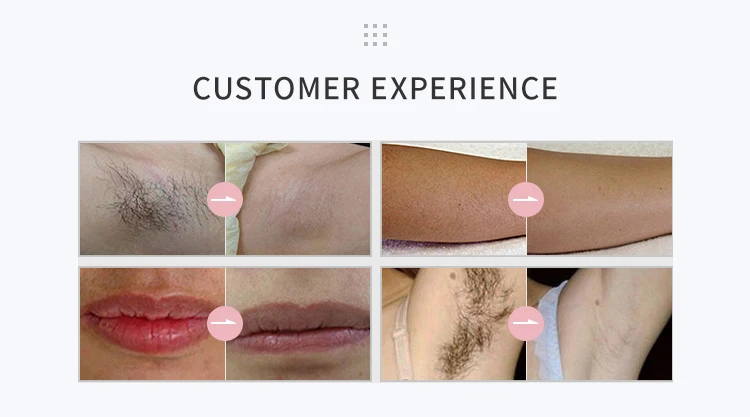 IPL-Hair-Removal-V-KCA410-part1_05