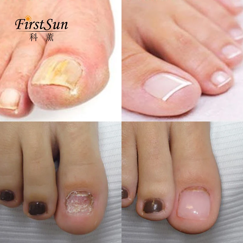 Firstsun 4ML Nail Nutrient Pen Removes Fungus Nail Repair Liquid Bright Nail Bio-Protective Film Nail Care TSLM2