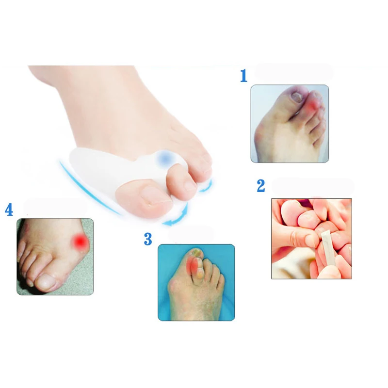 2Pcs Pedicure Concealer for Toes Gel Pedicure Stretchers Bunion Protector Straightener Bunion Corrector Foot Care Hallux Valgus