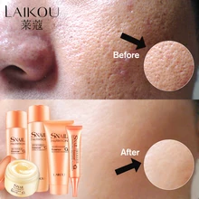 Набор для ухода за кожей с улиткой, 5 шт., очищающая пена, увлажняющий крем для лица, очищающее средство+ Тонер+ Лосьон+ крем для век возрасное отбеливание