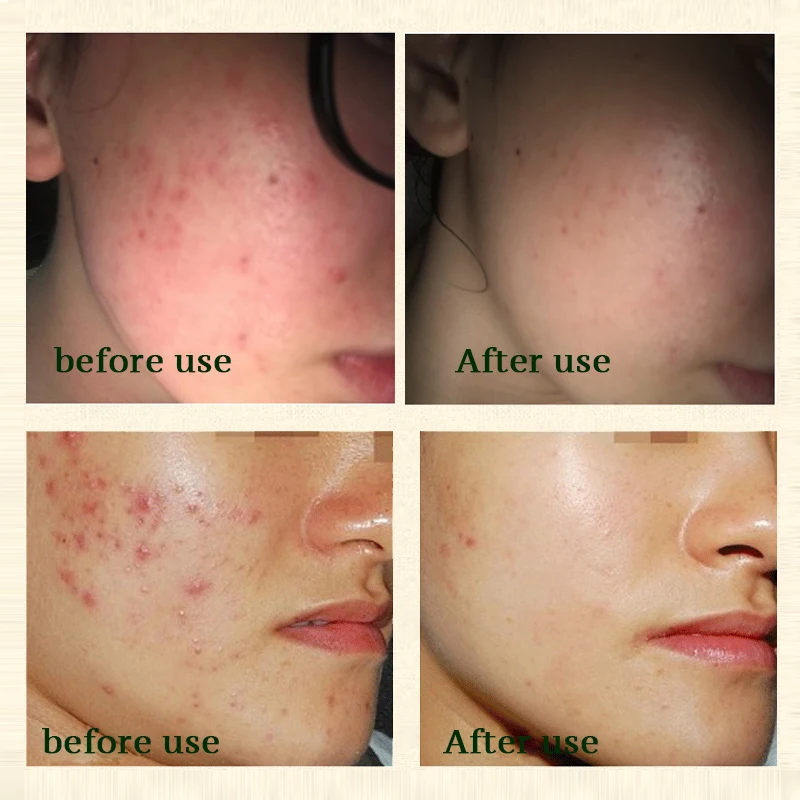 OMY LADY Strentch Marks акне крем для удаления шрамов лечение усадка пор гель отбеливания