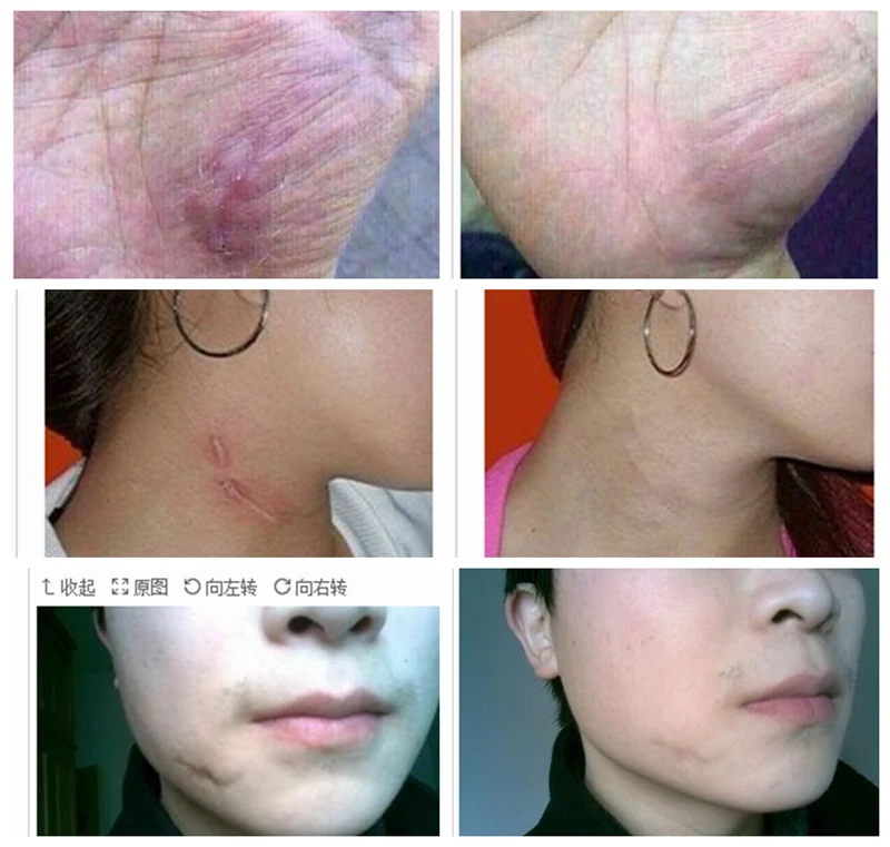 7 reviews no oil face marks,Remove lavender stretch scar scar oil essential