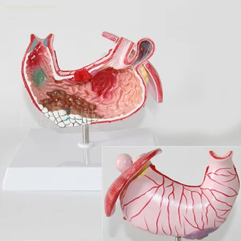 

stomach Anatomical model Gastric Distal Model Stomach Gastric Common Diseases