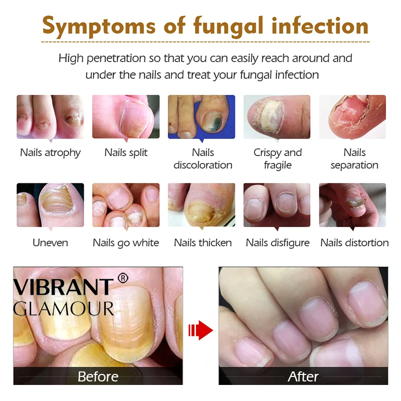 Восстанавливающая эссенция для ногтей, сыворотка для лечения грибковых ногтей, удаление онихомикоза, уход за ногтями и ногами, восстанавливающее жидкое эссенционное масло TSLM1
