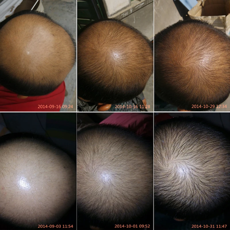 Hair Regrow Laser Helmet 64 68 Medical Diodes Treatment Hair Loss