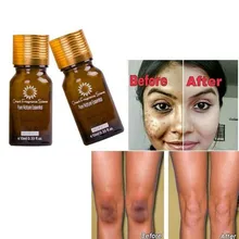 Уход за лицом отбеливающий крем Удаляет веснушки меланодермия пигмента меланина пятна от угревой сыпи удаления крем для лица