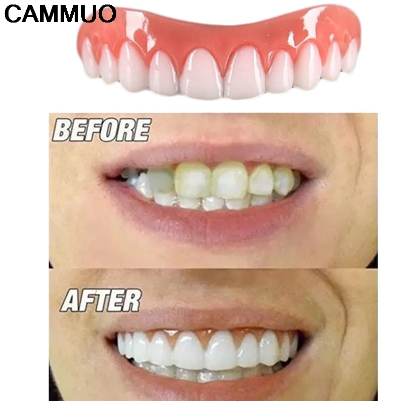 veneers