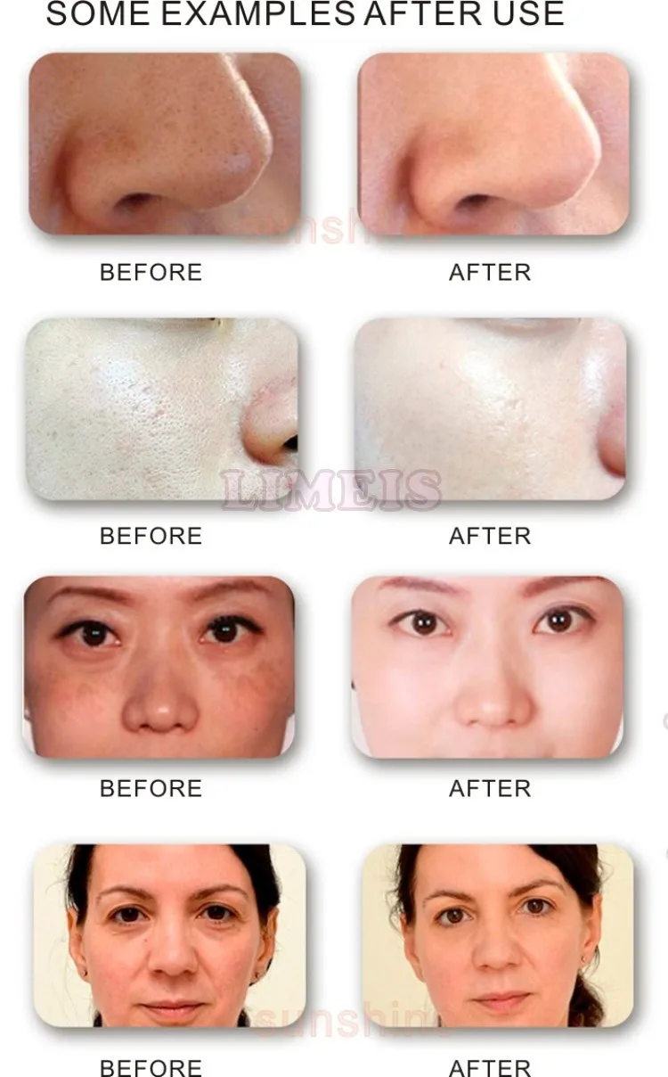 led facial machine mask Mascara facial de LED