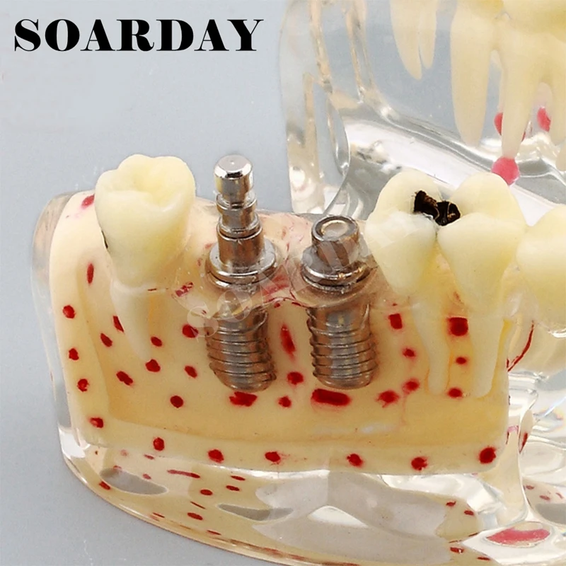 Implant Dental Model for Upper teeth Implant Spongy Bone Carious (2)
