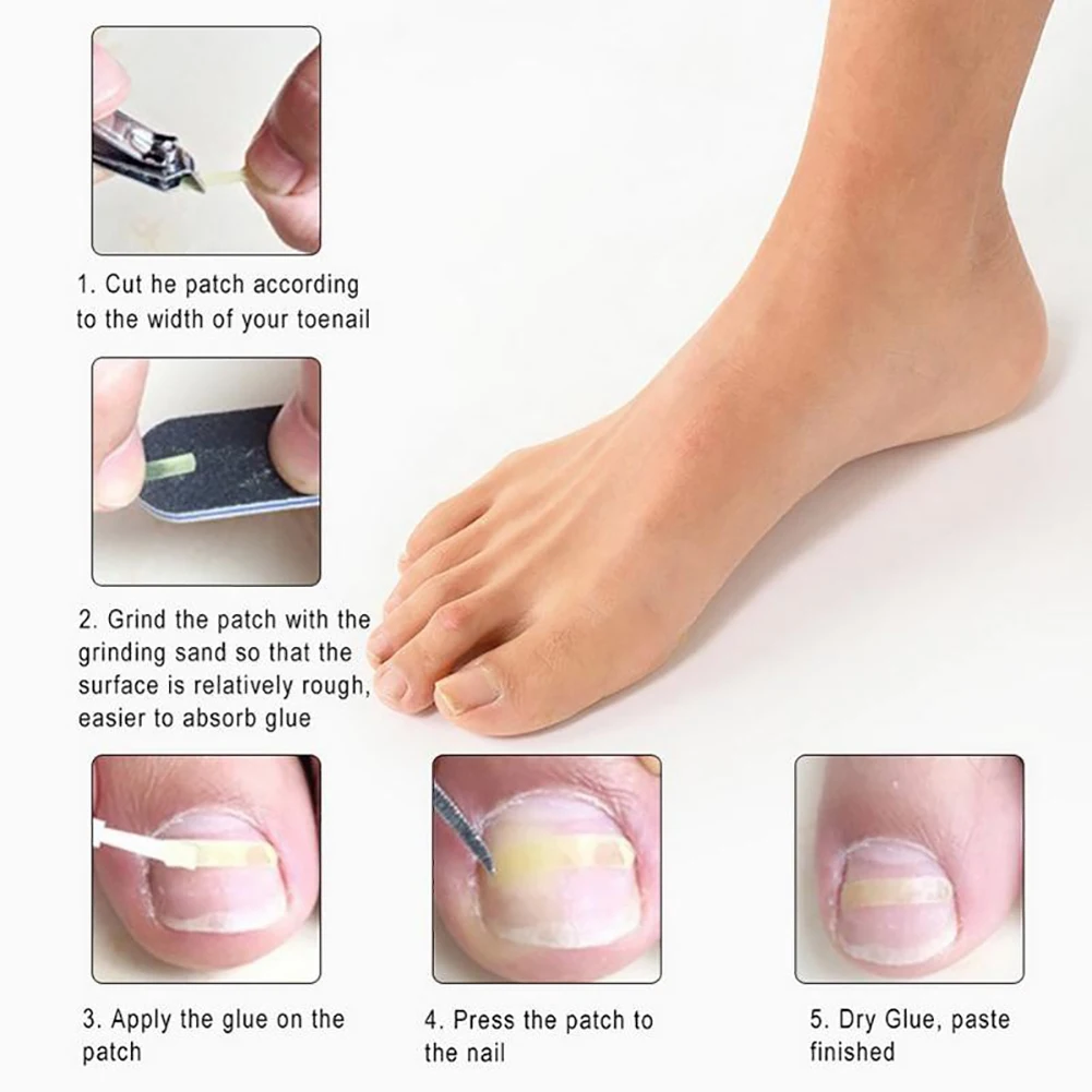 GUJHUI 10Pcs/Box Ingrown Toe Nail Correction Sticker Paronychia Foot Care Treatment