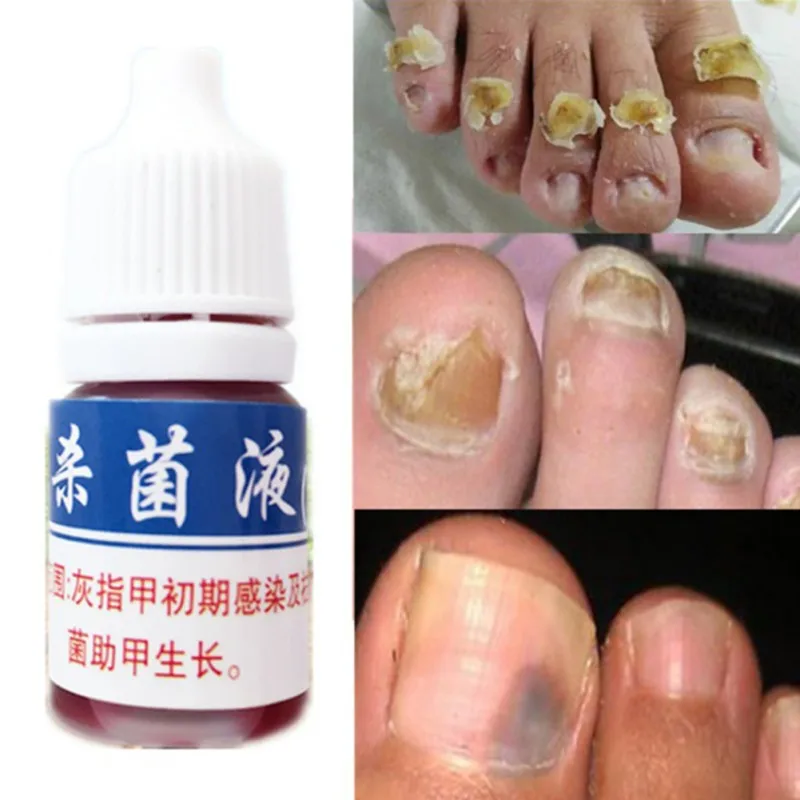 Полезное Лечение грибка ногтей против грибкового раствора для ногтей рингчервь чистый здоровый рост ногтей