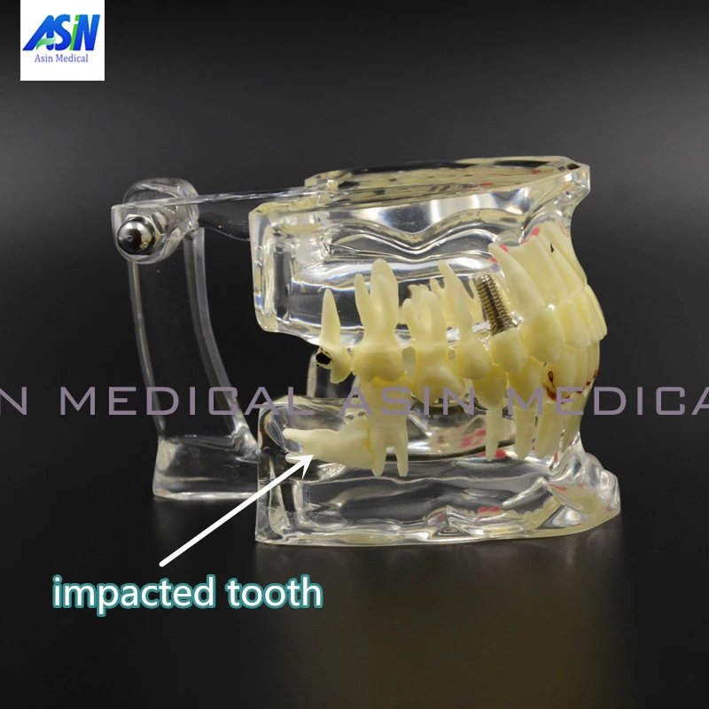 Dental Implant Disease Tooth Pathological Extrusion Missing With impacted tooth dental pathological teeth implant model dental implant biomaterials