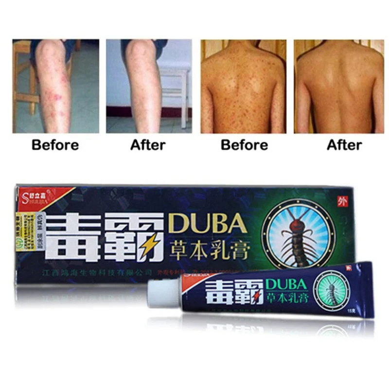 

Body Psoriasis Cream Perfect For Dermatitis and Eczema Pruritus Psoriasis Ointment Herbal Creams