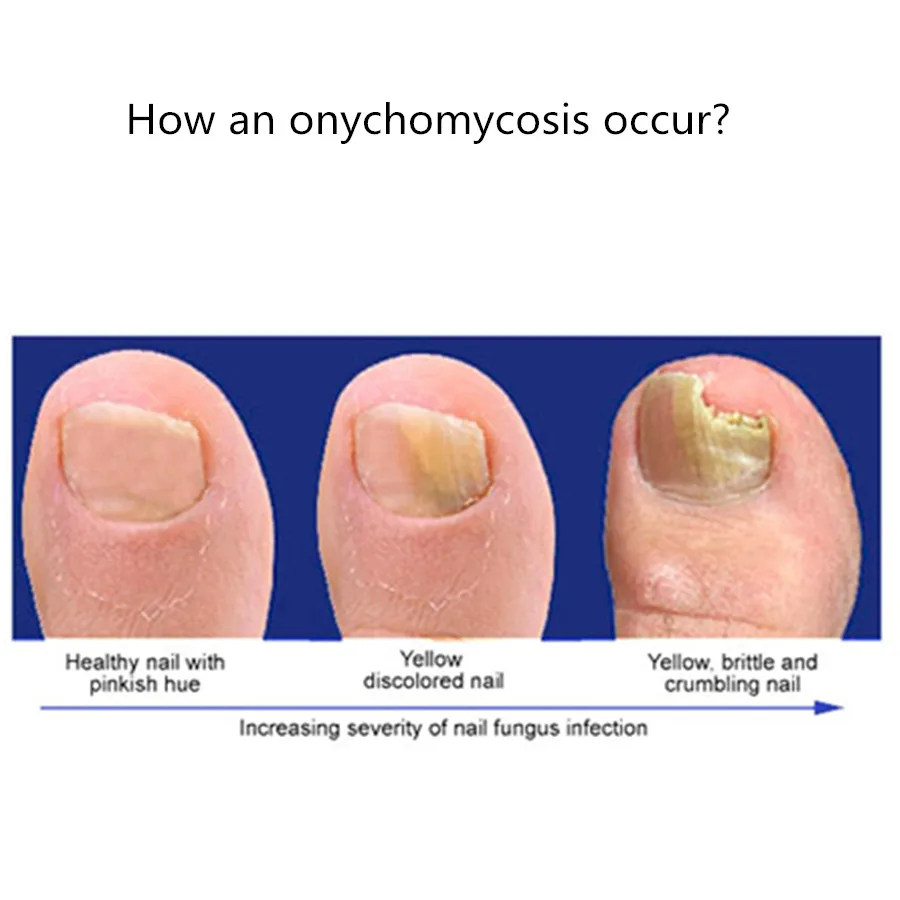 3 мл Китайская традиционная Onychomycosis dead Nail удалить Лечение Уход жидкая ручка смягчить Ноги Уход за ногами инструмент для лечения масляной ручки