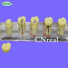 1 pc Dental Root Canal Treatment (RCT) Teeth Model Oral Endo For Teaching & Communication 1 pc Dental Root Canal Treatment (RCT) Teeth Model Oral Endo For Teaching & Communication