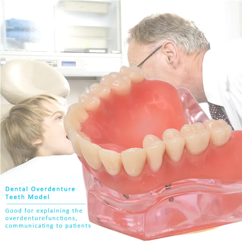 Mandibulares com Implante de Dente Modelo Teeth Dental Overdenture Removível Interior Mandibular Inferior Estudo Ensino Modelo Dentes 8 Modelo de Ensino Dental