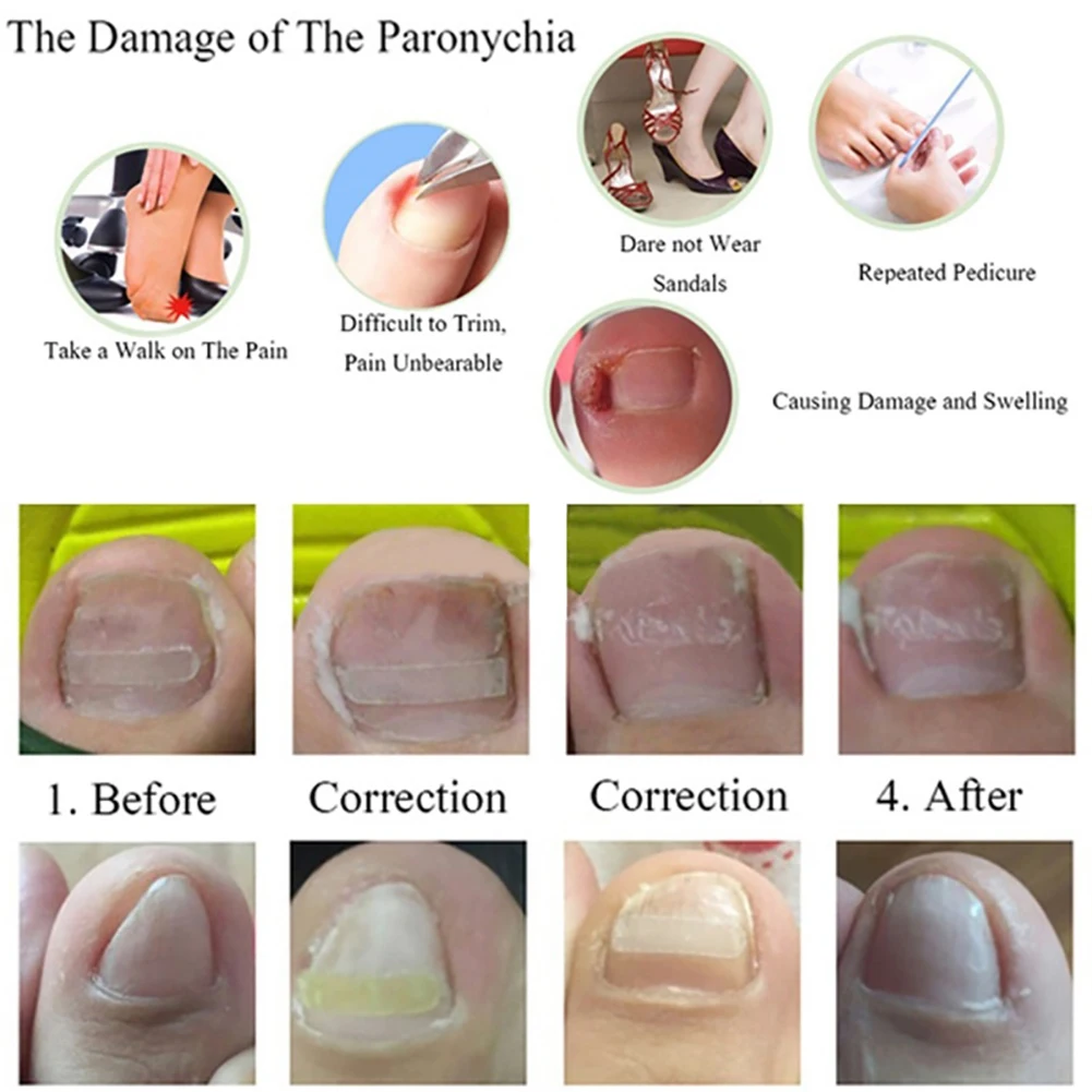 GUJHUI 10Pcs/Box Ingrown Toe Nail Correction Sticker Paronychia Foot Care Treatment