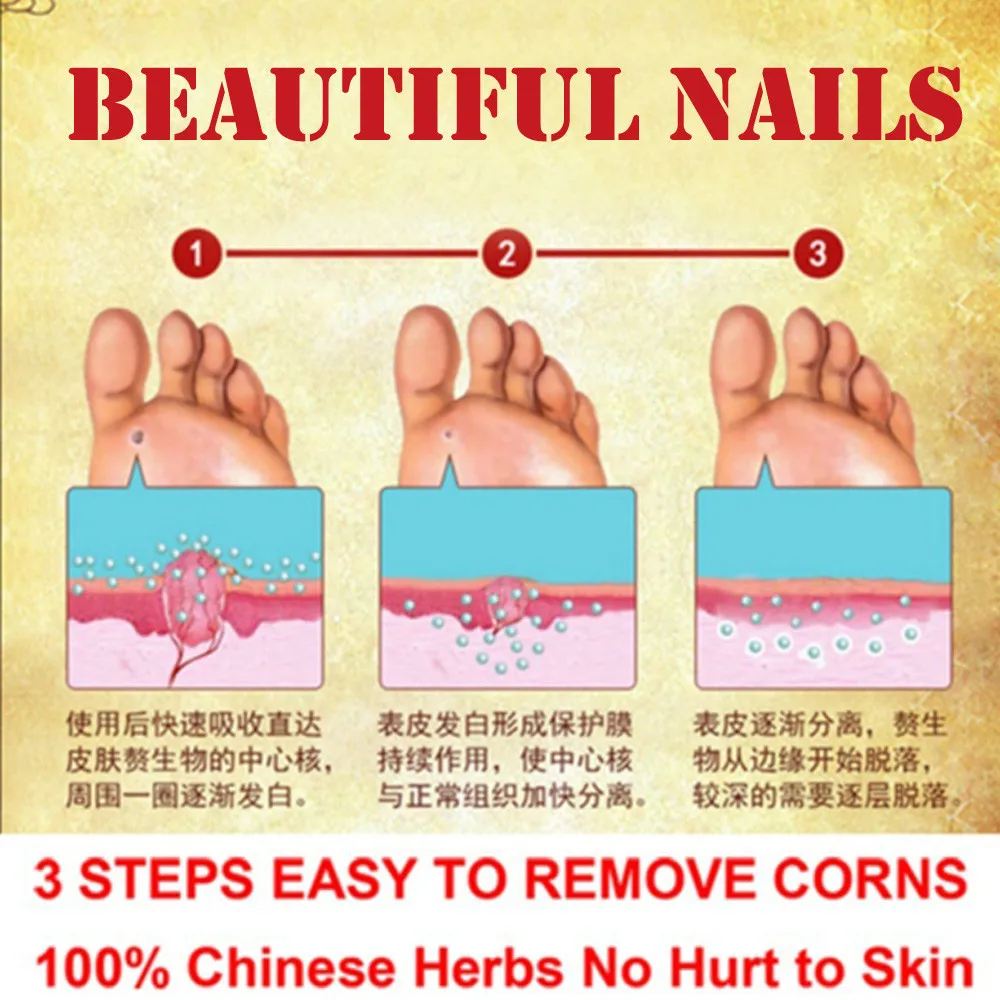 Прямая поставка лечение ног удаление кукурузы Plantar Verruga Уход за ногами жидкие