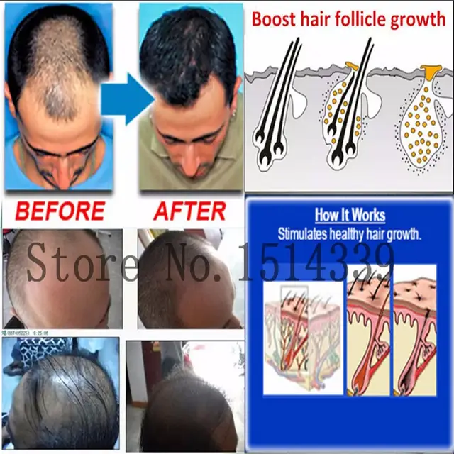 Online Shop 3pcs Sunburst Alopecia Areata Hair Regrowth Treatment