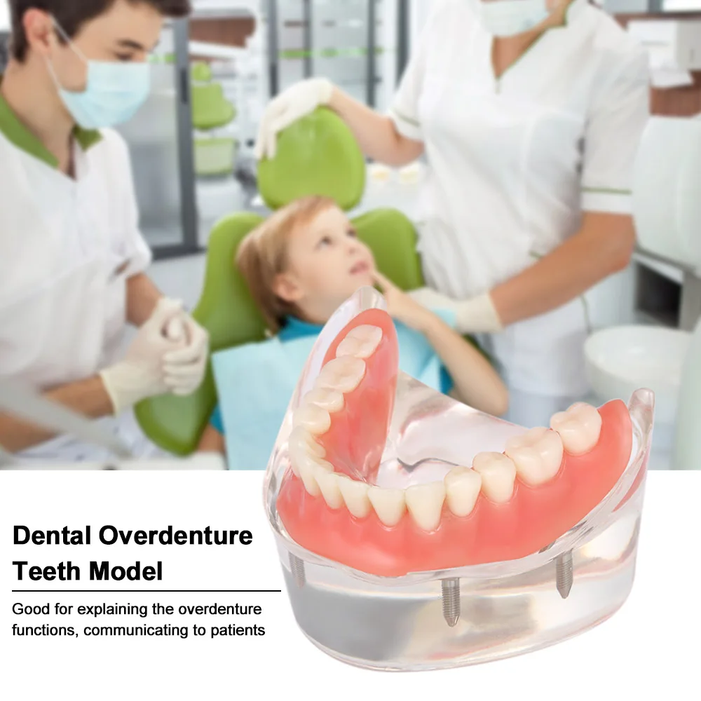 

Dental Teeth Model Interior Mandibular Lower Teeth Model Mandibular With 4 Implant Restoration Dental Teaching Study
