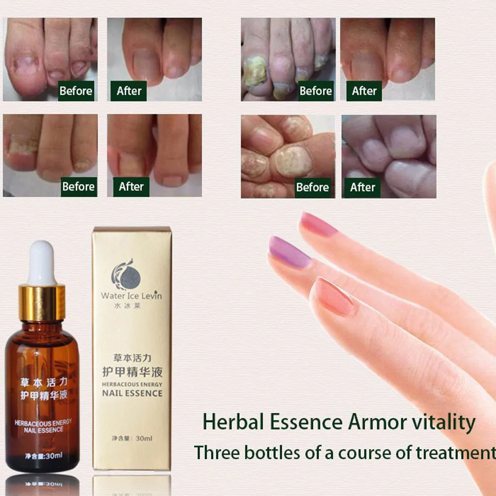 

Professional Nail Treatment Essence Nail and Foot Whitening Toe Nail Fungus Removal Nails Art Treatment For all gels hygiene #1