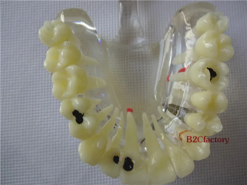 Зубные имплантаты болезни зуб патологических экструзии отсутствующих зубов Модель 4001