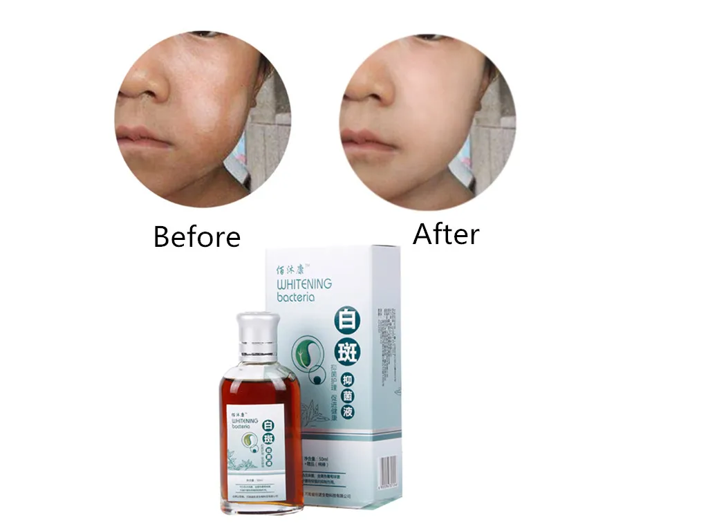 

Skin Liquid Repair Melanin White Spot Vitiligo Treatment Melanin Promoting 50ml