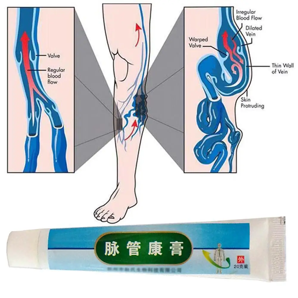 Китайская медицина Варикозная Вена мазь для массажа нижних конечностей внутривенная мазь паста спрей естественное лечение травами крем