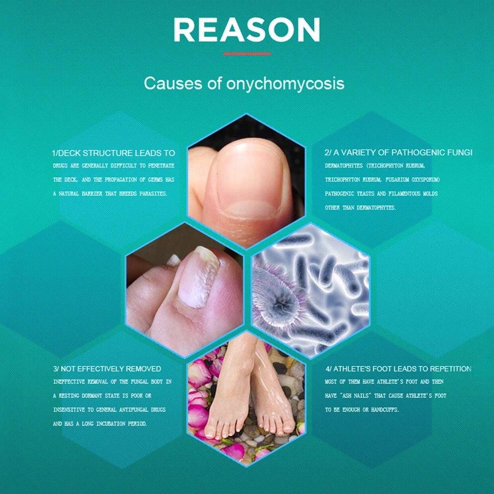 TYJR Nail Repair Care Fungal Nail Treatment 10ML/Bottle Nail Fungus Oil Onychomycosis Liquid Nourishing Oil