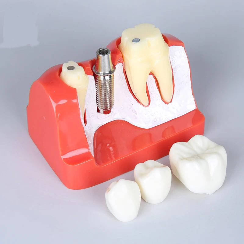 Стоматологическая модель образования/разъемная модель имплантата/мост Модель зубного имплантата/модель имплантата