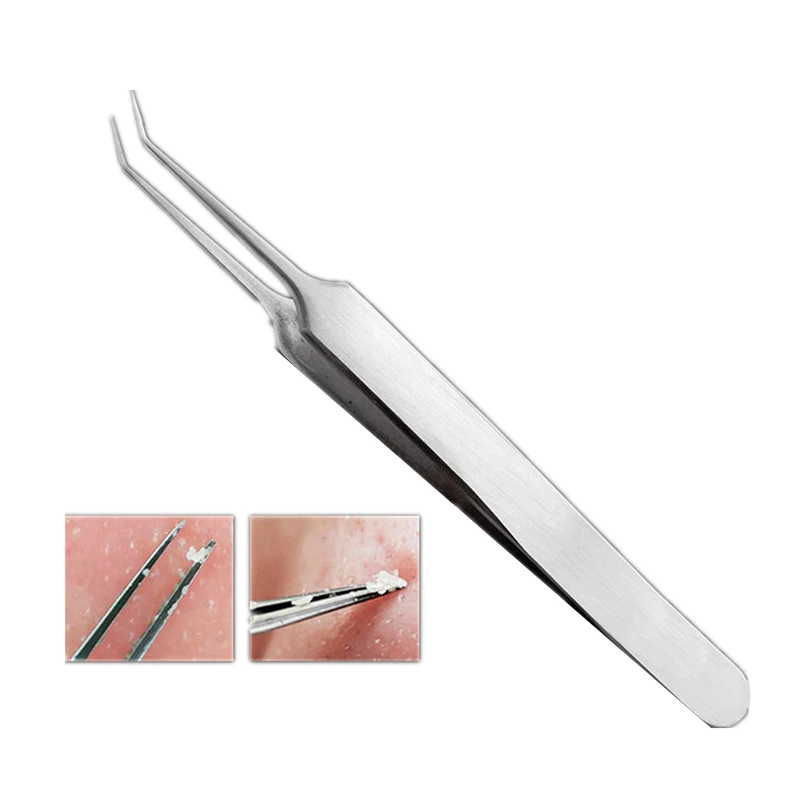 3pcs-set-The-High-Quality-Blackhead-Tweezers-Blackhead-Blemish-Removers-Blemish-Acne-Pimple-Extractor-Face-Skin (2)