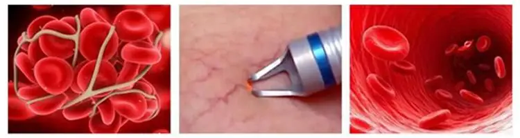 Эффективный лазер для удаления сосудов машина/лечение акне вены кровеносного сосуда машина красоты CE/DHL