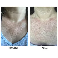 2 вида многоразового использования кремния Прозрачный против старения морщин удаления колодки против морщин груди подтяжка укрепляющая кожу Макияж лица TSLM2