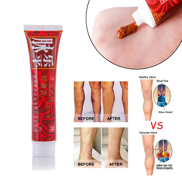 phlebitis treatment at home phlebitis treatment at home