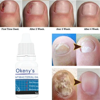 

Kill 99.9% Bacteria Nail Care Treatment Nail Fungus Oil Onychomycosis Paronychia Anti Fungal Nail Infection Repair Treatment 5ml