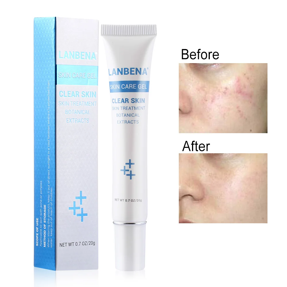 20g Face PimplesTreatment Cream Skin Care Gel Remover Anti Acne