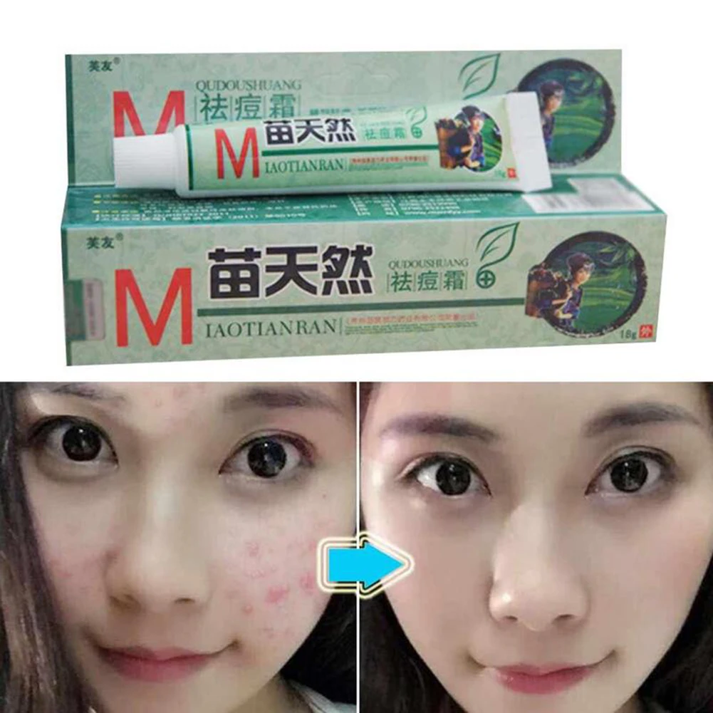 

Hot Sale Acne Remove Cream Blemish Spot Pimple Treatment Moisturizing Facial Skin Care Tool
