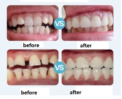 

Tooth Orthodontics Braces Bucktooth Anti Molar Orthodontic Retainers Dental Orthotics Treatment Trainer Teeth Whitening
