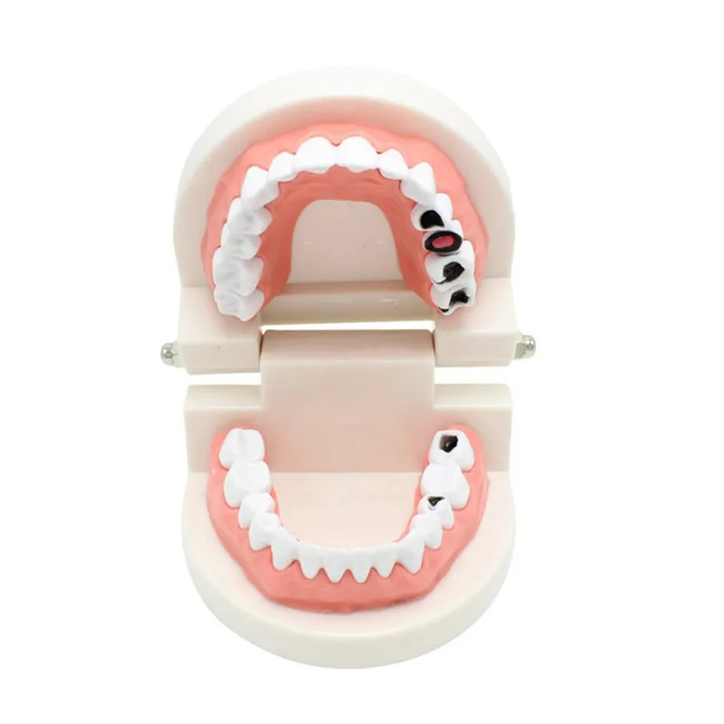

Dental Caries Model Study Teaching Decay Tooth Model Teeth Care Dental Model for Teaching Dental Lab Model Dental Material